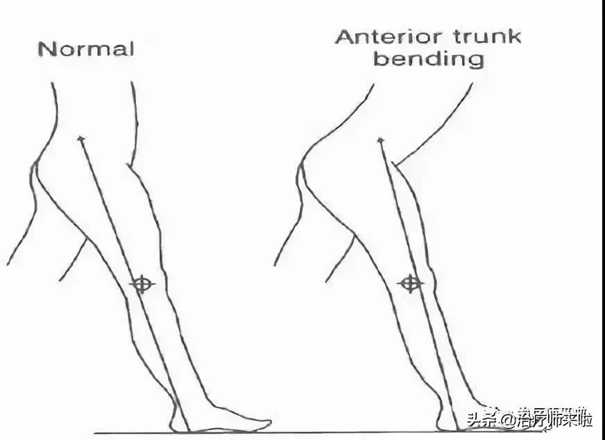 常见的异常步态醉酒步态,步态异常的十大特征有哪些图片
