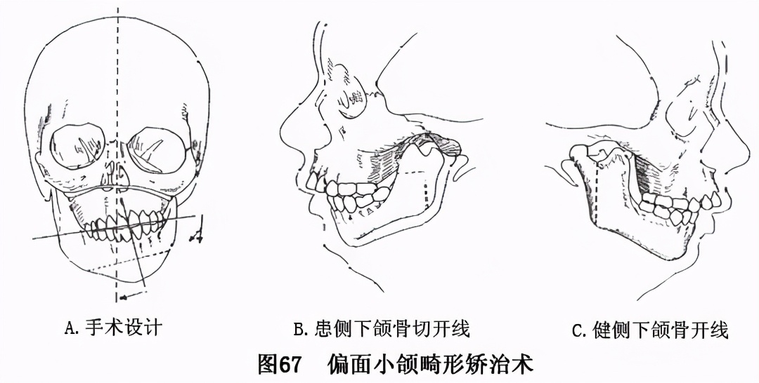 歪脸严重怎么调整,歪脸怎么改善最有效