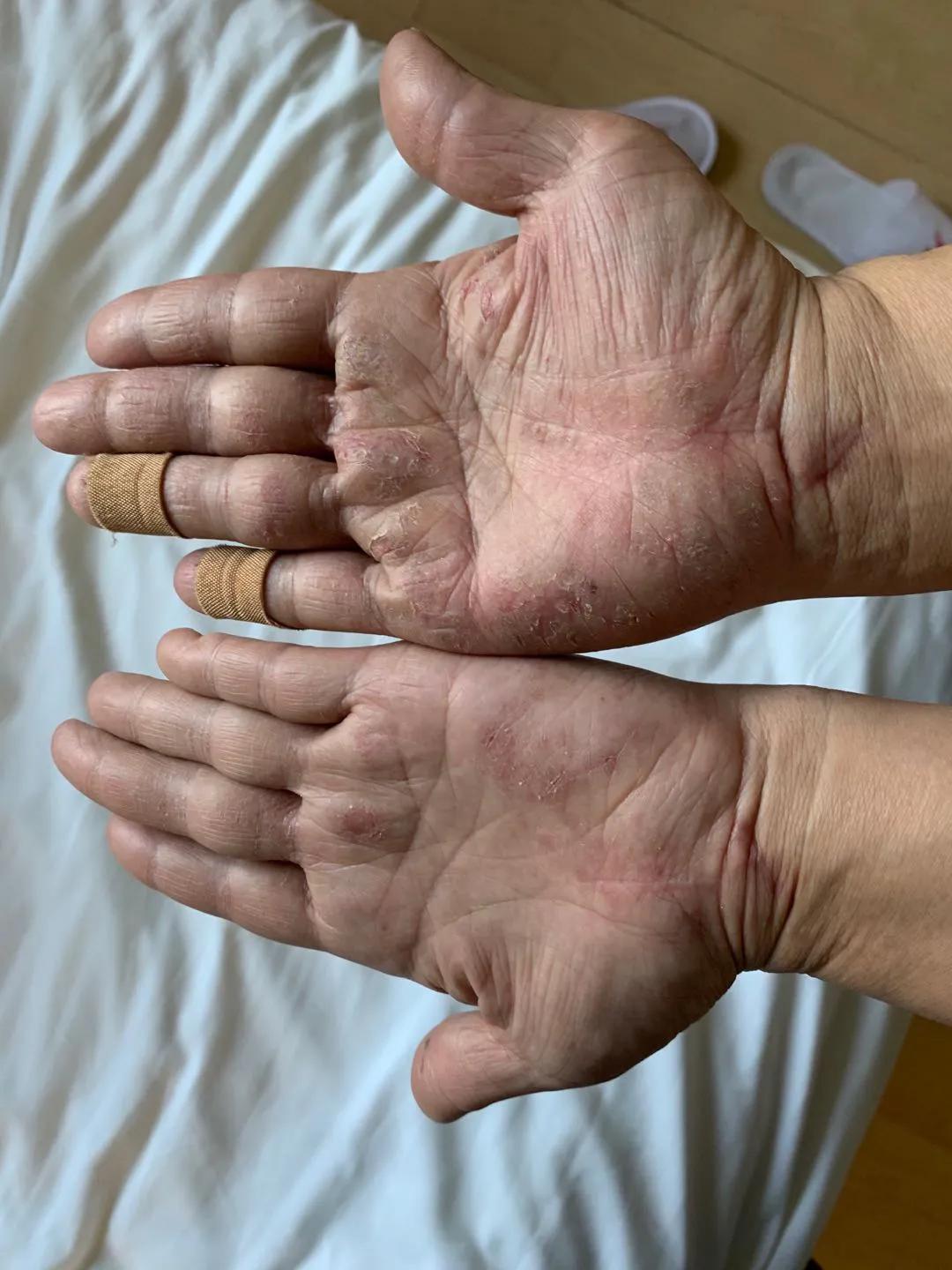 夏天手上脚上起水泡,手一到夏天就起水泡很痒