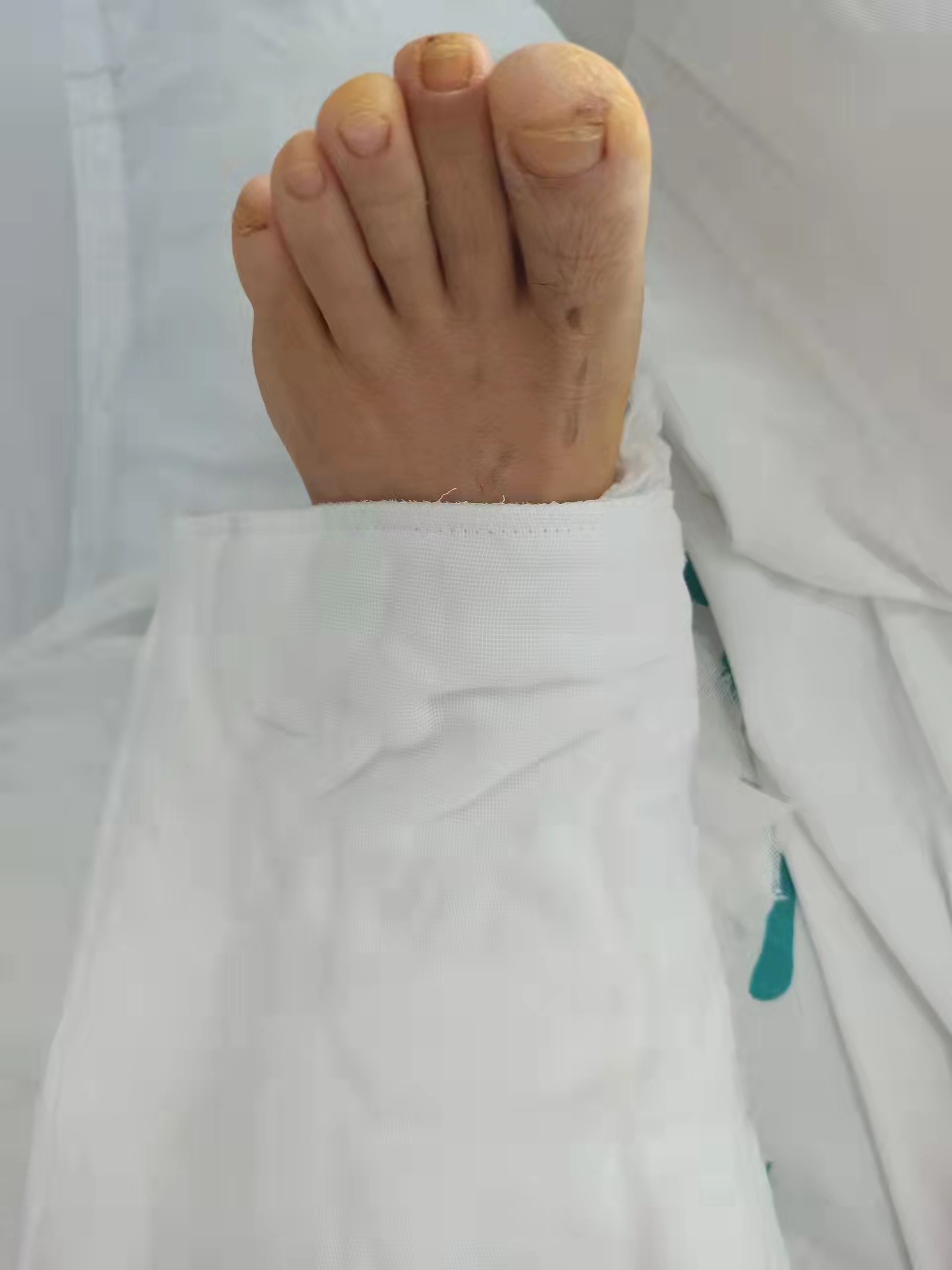 小腿骨折后走路瘸怎么矫正,小腿外踝骨折畸形愈合10年后遗症