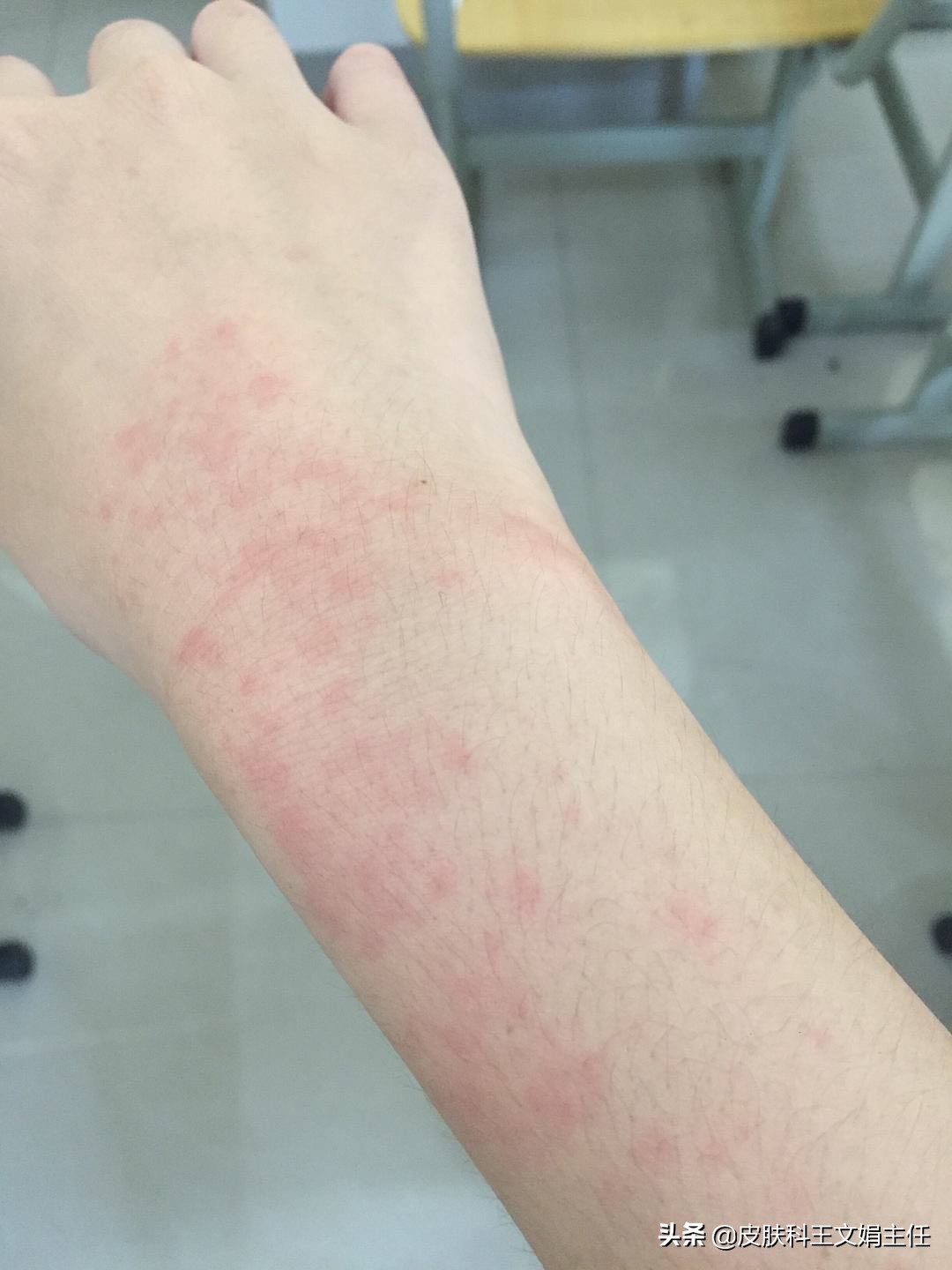 夏天皮肤病的预防,夏天常见皮肤病诊断及用药图谱