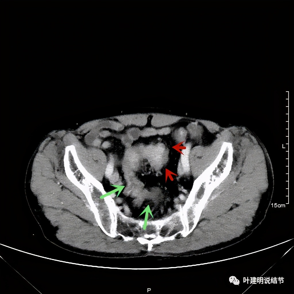 同时患结肠癌和直肠癌怎么办,同时查出了胃癌和肺癌怎么办
