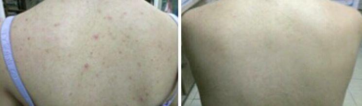 日本去螨虫皂,日本小黑皂号称螨虫克星