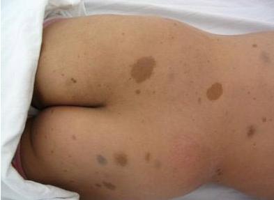 「热点资讯」臀部长胎记似恐龙，这个英国小妹火了