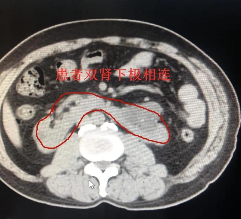 男子为什么左肾有多个结石,男子肾结石发现自己有三个肾