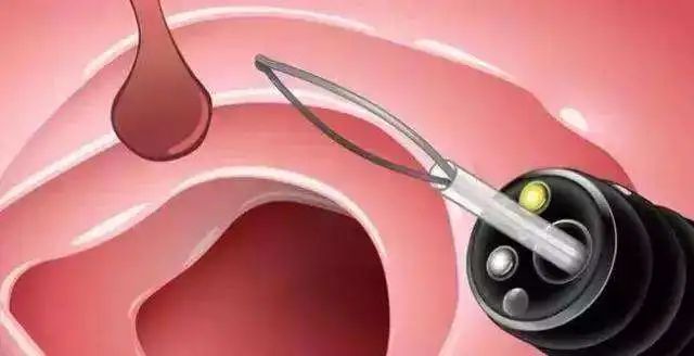 幼儿大便有血直肠息肉,孩子拉粑粑为什么会有血