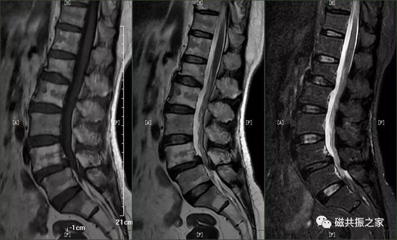 腰椎有哪些病变,腰椎病变有几种