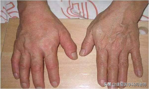 脑卒中后偏瘫患者常见并发症:肩手综合征的康复治疗