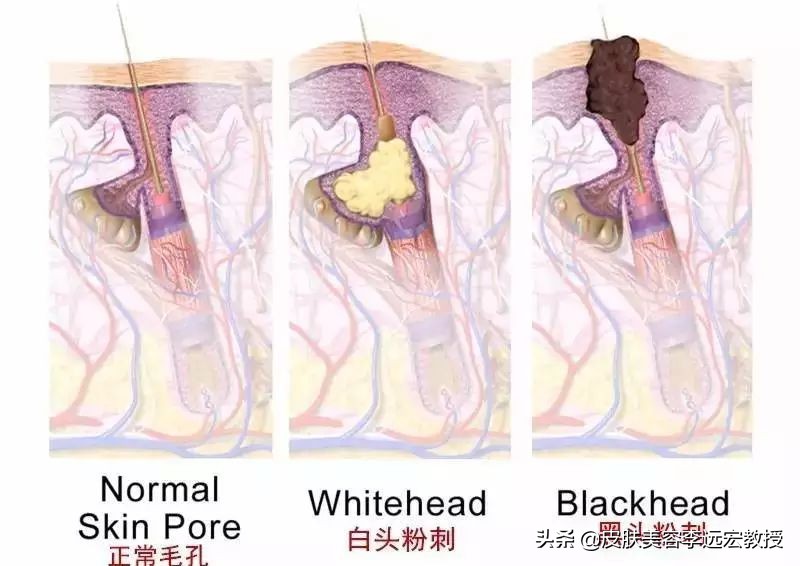 毛孔堵塞是病吗,皮肤暗沉毛孔堵塞怎么办