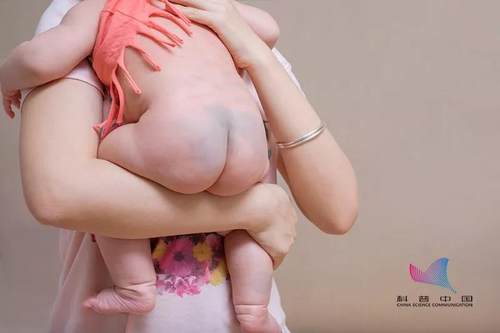 为什么宝宝屁股上有淤青,为什么新生婴儿屁股有黑青