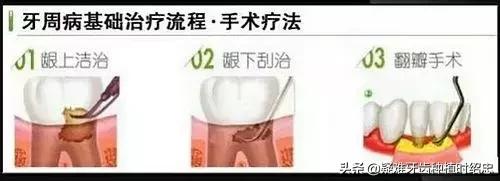 牙周炎牙齿松动要拔掉吗,牙周炎引起牙齿松动严重需要拔吗