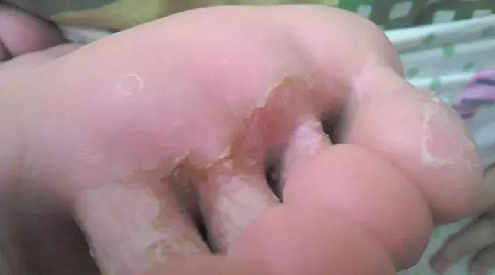 夏天不想穿凉鞋又怕得脚气怎么办,脚气夏天穿不了凉鞋怎么办