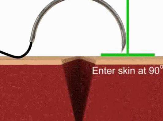 十种外科基本缝合方式详解,手术切口缝合有哪几种