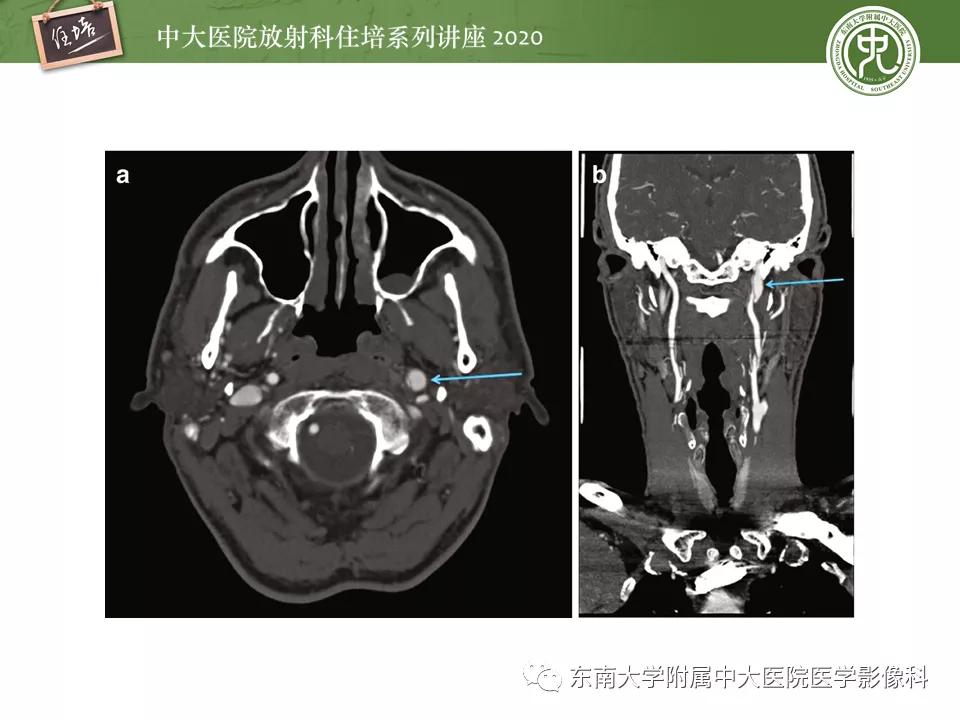 颈动脉夹层的超声表现及漏诊分析,动脉夹层与夹层动脉瘤是一样的吗