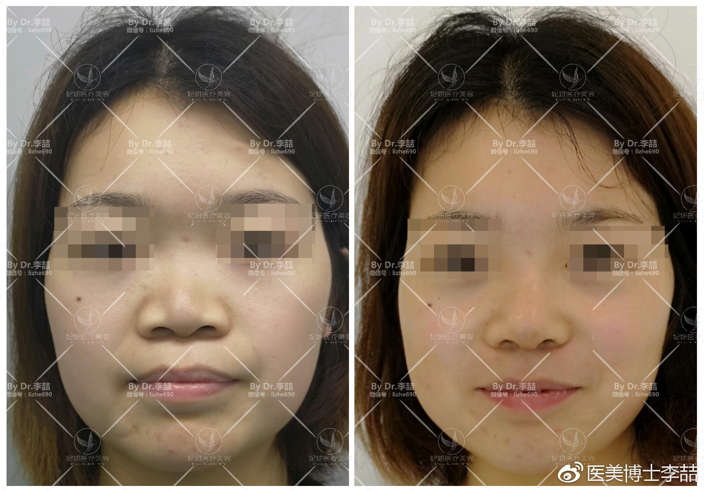 先天性鼻缺损和畸形的修复,先天性鼻中隔缺损