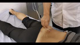 腰椎间盘突出引起的腰腿痛，如何针灸效果好？纯干货