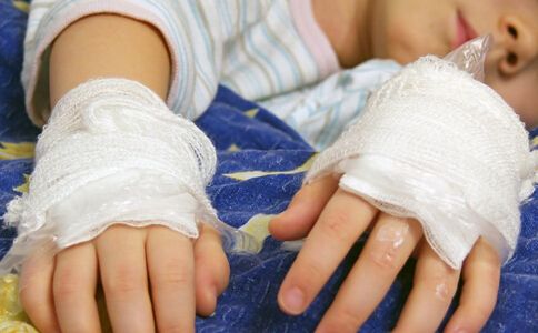 孩子烫伤后最佳治疗时间只有120秒,孩子烫伤恢复过程