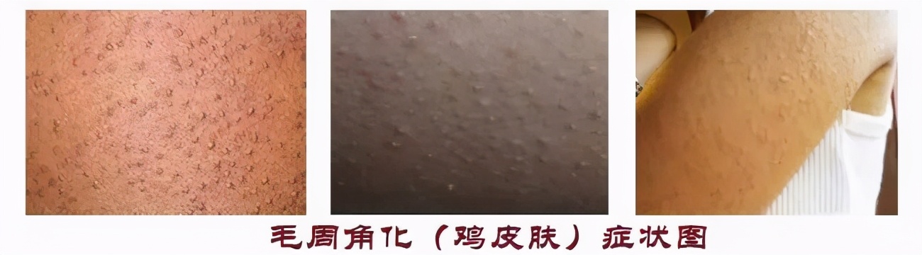 小孩脸颊两侧有小疙瘩像鸡皮,脸颊两边长鸡皮疙瘩