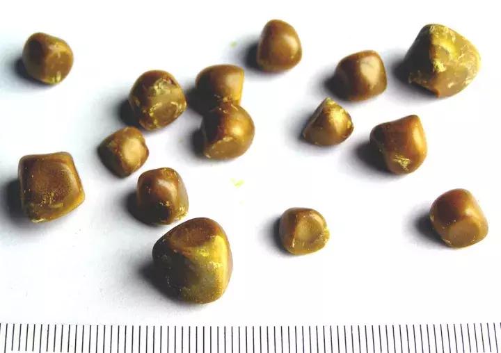 碎石完没有石头了腰还是疼,碎石后没感觉有石头排出来