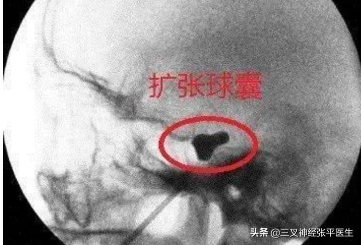 牙疼三叉神经痛的最佳解决办法,耳朵三叉神经痛的最佳解决办法