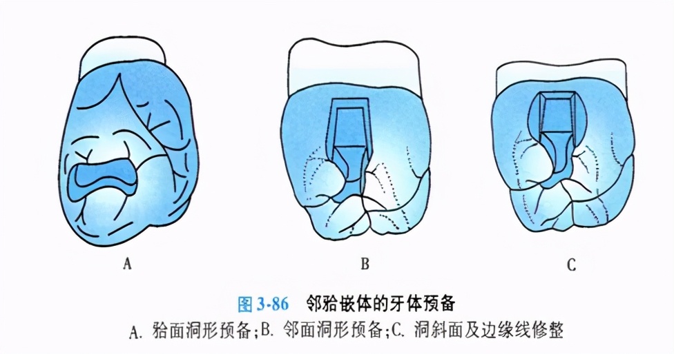 牙科嵌体的处理,牙科医生讲义