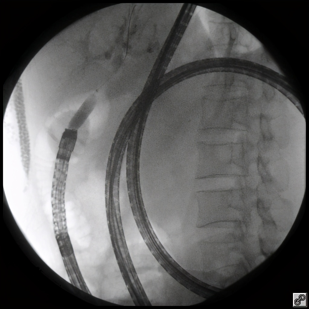 八年胆汁流通不畅,老奶奶成了“小黄人”……