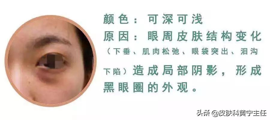 黑眼圈用中医治疗法,黑眼圈的分型和对症治疗