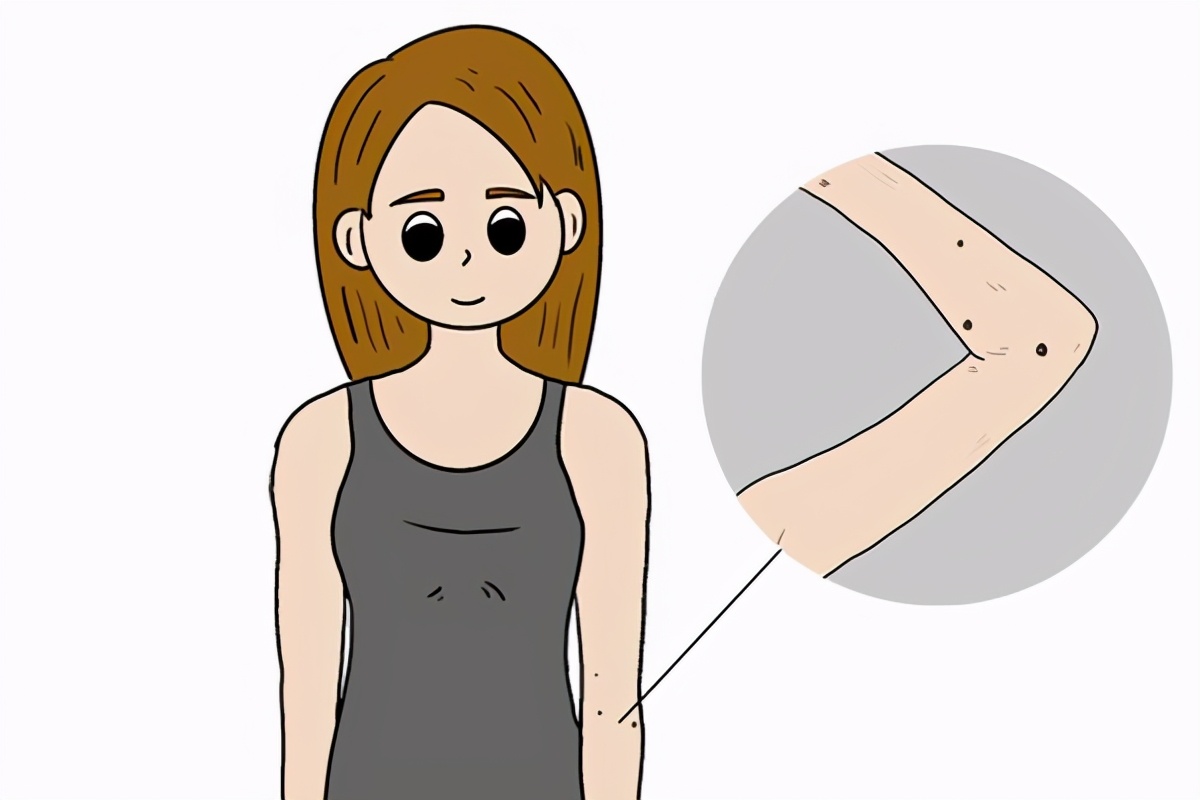 身上起红痣很痒怎么回事,身上突然起红痣很痒怎么回事