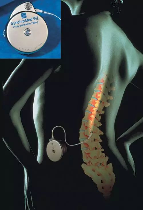 神经元修复治疗癫痫最近进展,癫痫治疗新方法神经调控治疗