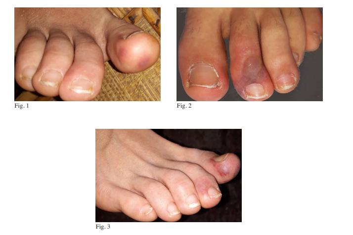 新冠新症状脚趾红疹,新冠肺炎可疑症状患者