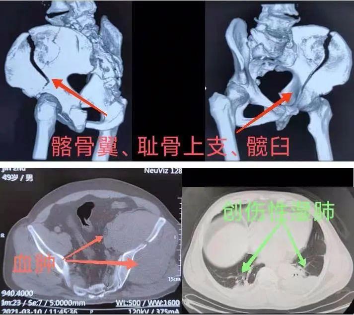 丨传承·创新丨——多学科协作奏响凶险骨折患者生命乐章