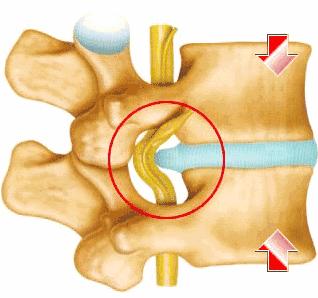 腰椎间盘膨出和滑脱手术会瘫痪吗,腰椎间盘膨出双下肢麻木会瘫痪吗