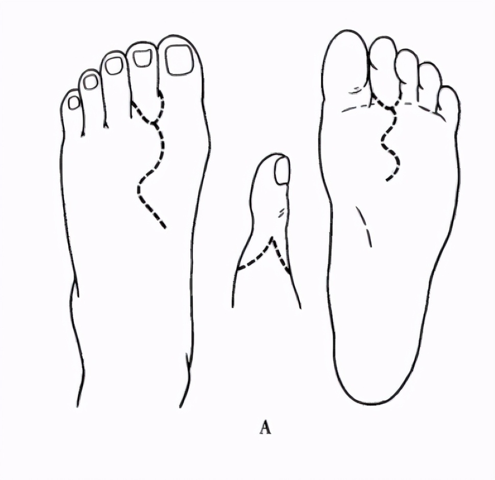 手指没了可以用脚趾代替吗,手指没了可用脚趾接吗