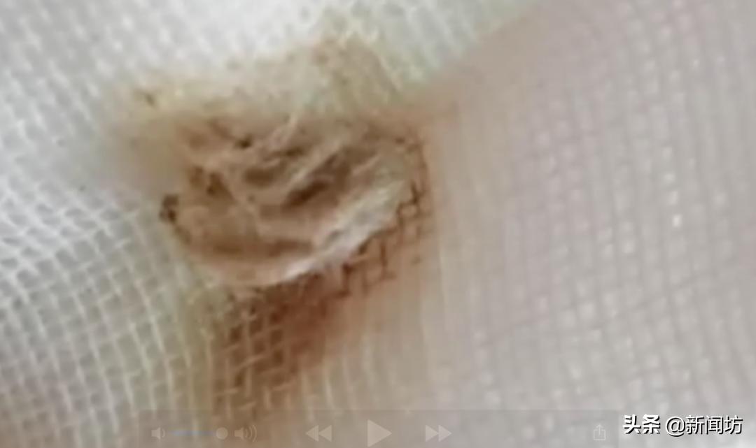 2岁女童*体下**间断性出血，还有异味！母亲怀疑性早熟，原因意外