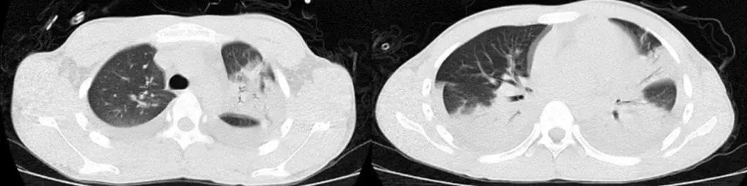 抗菌药物不合理处方分析,抗菌药物用药不合理的表现