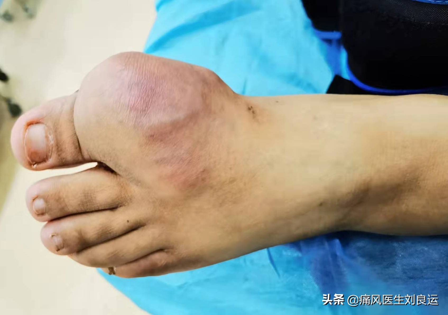 痛风降尿酸吃什么食物最快,痛风怎么吃才能降尿酸