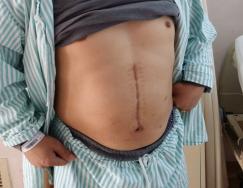 肝硬化及炎症手术的难度很大,肝硬化细胞治疗最新临床课题