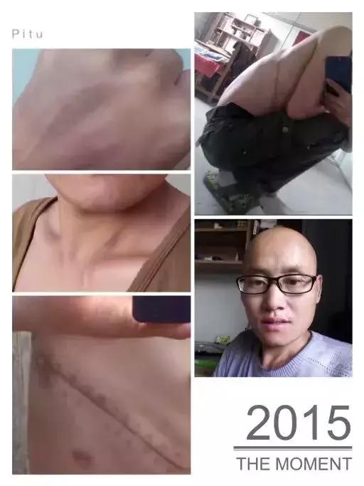 每天跑步五公里治愈癌症,有氧跑步战胜癌症的案例