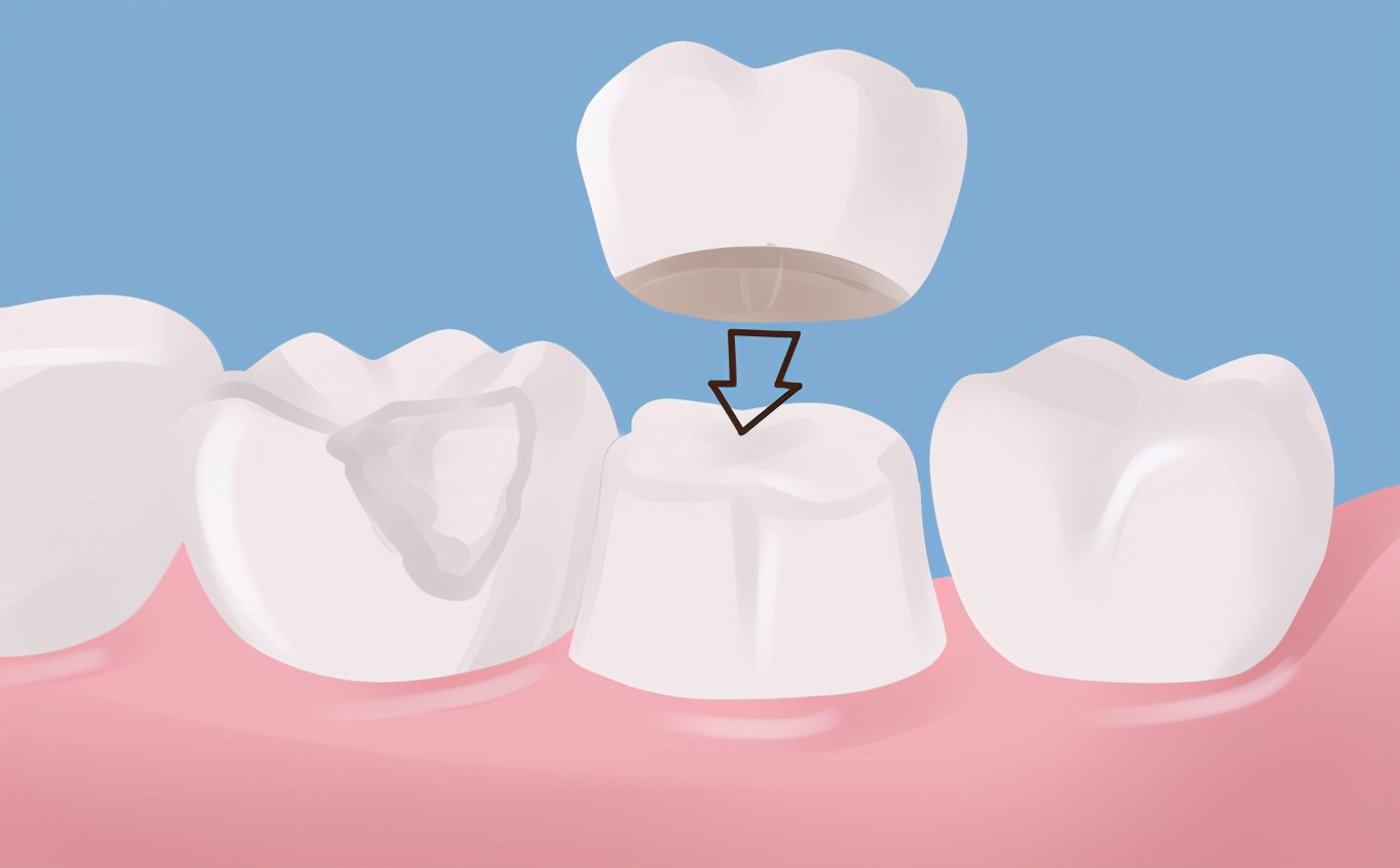 牙齿缺损修复的方法和技巧,牙齿楔状缺损修复图片