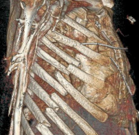 外卖小哥逆行被撞成手臂骨折,逆行的外卖小哥撞到我怎么办