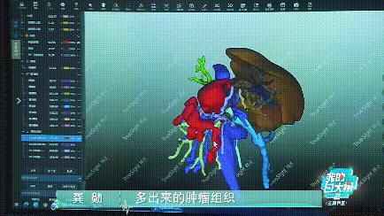 把肝脏取出来,把肝取出来会怎么样