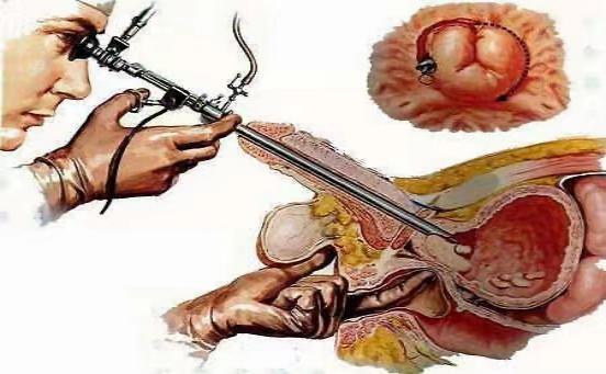 前列腺增生影响膀胱功能如何治疗,抑制前列腺增生草药方剂