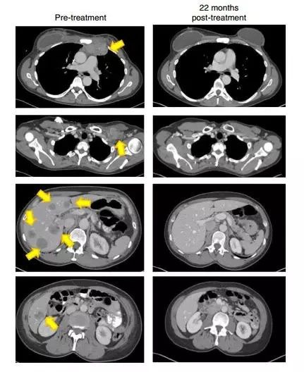 定了！首款针对实体瘤的细胞免疫疗法有望明年获得FDA批准上市