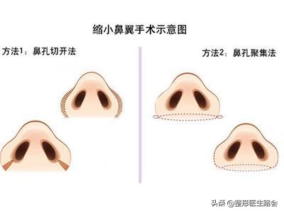 鼻子是怎么垫高的,鼻子垫高点更完美了