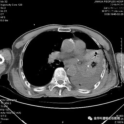 手术引起乳糜胸,有没有做了肺结节手术后是误诊的