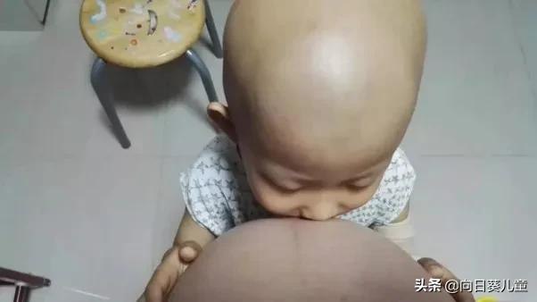 最常见的儿童癌症,2023国际罕见病日带您了解罕见病