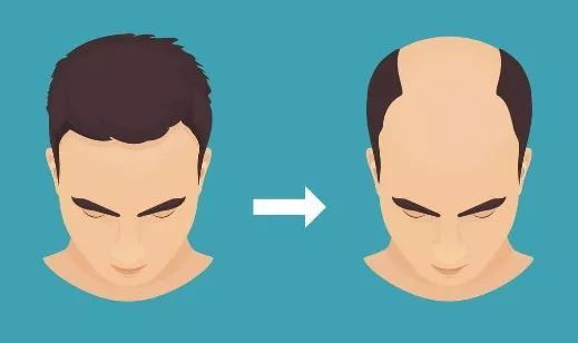 秃顶这件事就过不去了?两项新研究为治疗脱发带来新希望