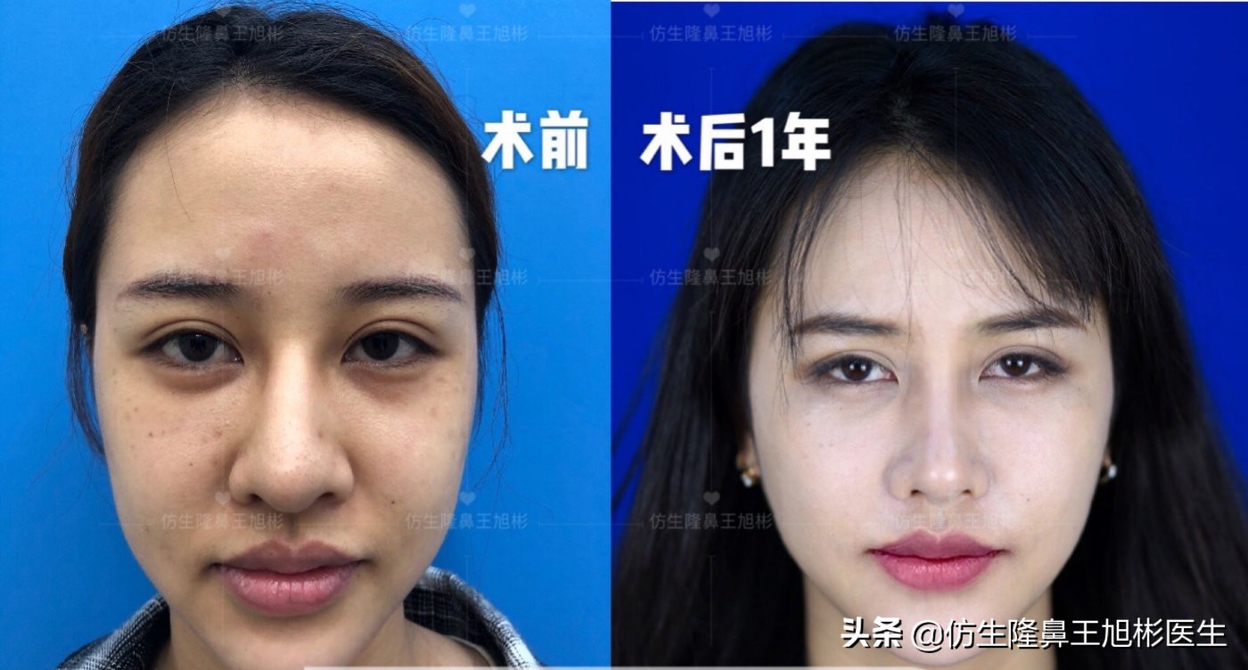 外切缩鼻翼的后遗症,外切鼻翼缩小会回弹吗