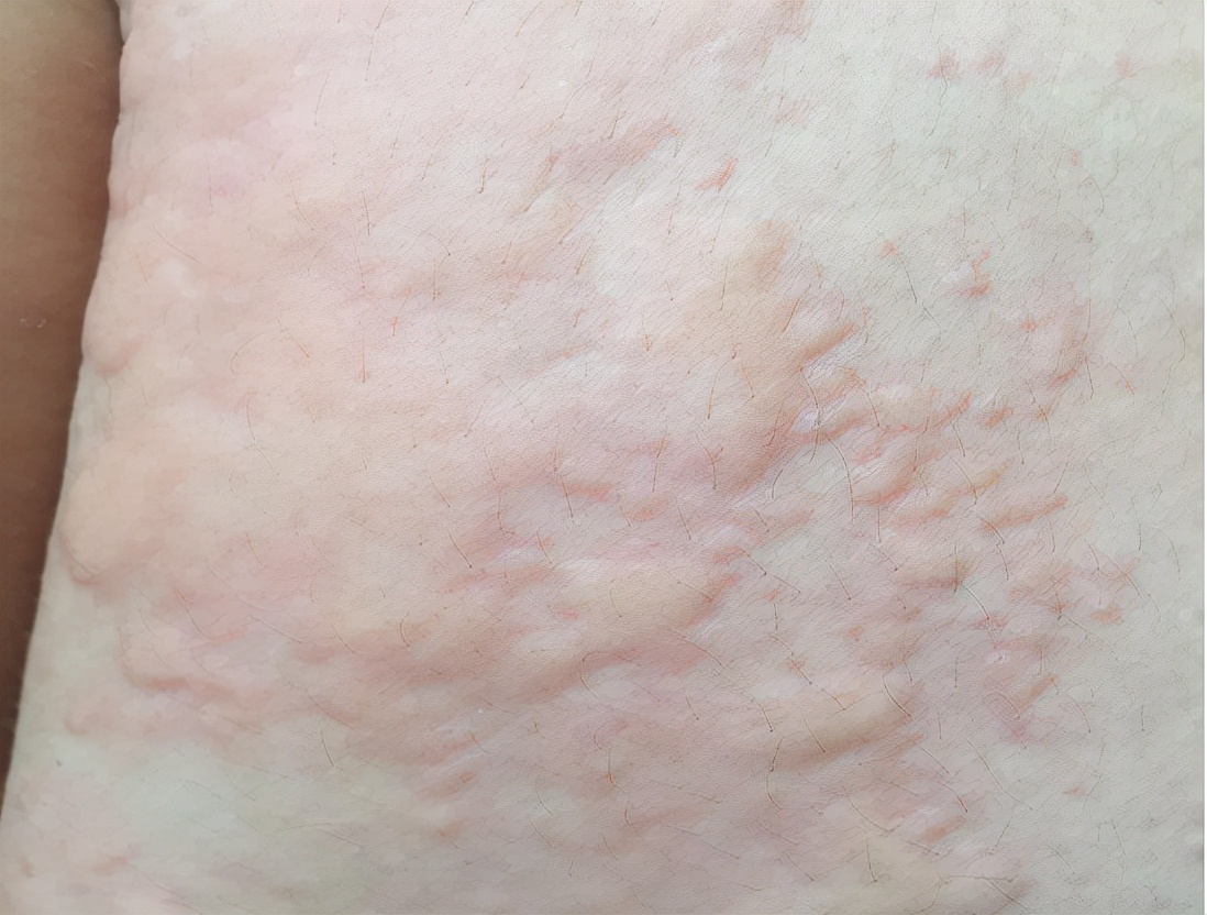 荨麻疹缓解瘙痒的方法是什么,荨麻疹瘙痒难忍可以用什么缓解