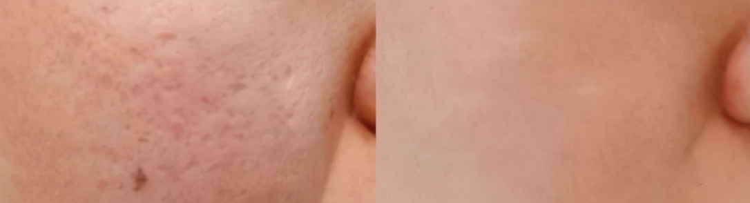 面部松弛下垂的最好解决办法,面部松弛下垂的最快恢复办法